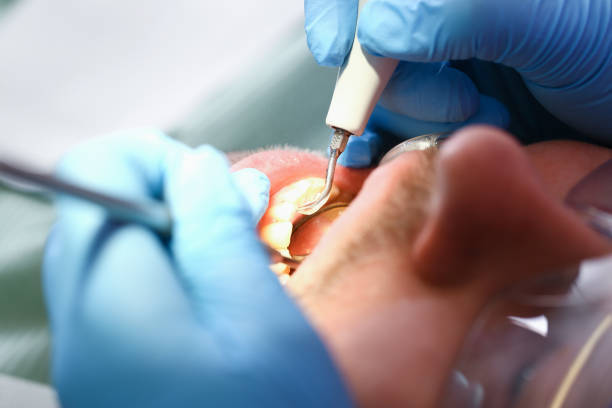 Best Emergency Dentist for Lost Fillings or Crowns in Marietta Alderwood, WA